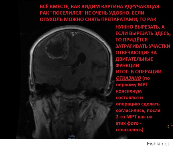 Вот фото (слабонервным не смотреть, но такова жизнь что это может случится с каждым, если почувствовали немение пальцев, быыыстро на МРТ!!! Кто знает что дальше будет! Если конечно вам дорога ваша жизнь):