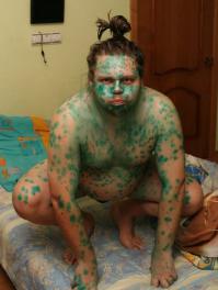 Последствия обработки царапин