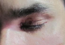 рассказываю свою историю...
живёт у нас полудикая корова тубинской породы, что видела людей не ближе расстояния метров 100... так вот волей случая попала к нам на попечение - приручили, оказалась весьма ласковой и игривой :)
утром в потёмках пошел корову кормить - фонарик, гад, погас - я наклонился, она меня не видела, я её - засвет от фонарика остался - и рогом в глаз. по касательной с лева от меня, рассекла веко, удар в переносицу со стороны левого глаза, я отлетел ударился головой об балку... глаз целый, теперь вот неделя прошла... голова болит и кружится, лёгкий отёк мозга... капельницы и всё такое :)
повезло...