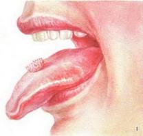 6 - ВПЧ на языке)