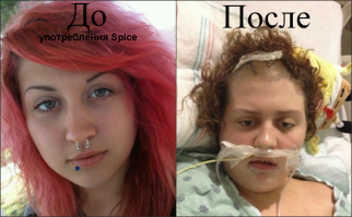17-летняя Эмили Бауэр из Техаса ослепла и получила серьезные повреждения мозга после всего лишь одного употребления наркотика под названием "спайс". Именно это наркотическое вещество превратило обычную девушку в "овощ".