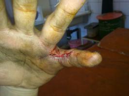 Снимал несколько дней, как заживает рана