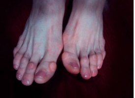 Потом обзаведётся вот такими "красивыми и здоровыми" ногами.