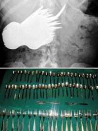 Туши свет батенка...
грната, лампочка, бутылка, 350 монет( 650$ ), и наконец 78 различных столовых предметов в желудке...
Что это за пеззёжь такой, и как это возможно...?