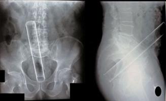 Лёгонькая анатомическая поправка: на первых снимках и некоторых далее не желудок, а толстый кишечник. В коментариях к рентгенограммам речь идет о брюшной полости и желудок один из органов расположенных в её верхней части (снизу запихнуть не получится). И немного их своей коллекции.