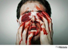 Парень похудел на 122 килограмма и теперь собирает деньги на операцию