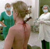 Когда 22-летняя Юлия Попова, жительница Москвы, возвращалась домой с работы, на нее напал вооруженный грабитель. Он ударил девушку в шею ножом с 15-сантиметровым лезвием, но она, вероятно, пребывая в состоянии шока, ничего не ощутила и, несмотря на сильно кровоточащую рану, смогла благополучно добраться в безопасное место. 

Когда Юлия пришла домой, напуганные родители сразу же отвезли ее в больницу, где хирурги успешно извлекли нож из тела девушки.