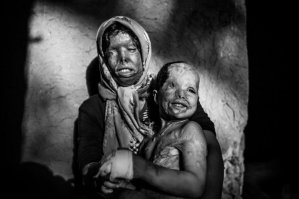 2 фото - не сын, а дочка. Мать - Сомаех Мехри, дочь Рана. Муж Сомаех - Амир, наркоман и вор. Облил их ночью кислотой, чтобы жена от него не ушла.
вот они же