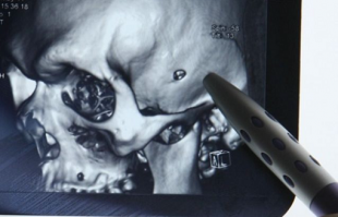 В Боснии во время матча пуля попала вратарю в голову. Он продолжил играть

Во время любительского футбольного матча в пригороде Сараево произошел странный случай. Пуля попала в голову вратарю одной из команд.

51-летний Душко Крталица продолжил играть и довел матч до конца. Он сыграл неплохо, несмотря на ранение, пропустил только 1 гол.

У голкипера заболела голова, но он посчитал это следствием удара головой о штангу.

После игры футболиста доставили в больницу в Сараево, где во время рентгеновской съемки врачи обнаружили пулю. Вратарь успешно перенес операцию.

По версии издания, пуля могла прилететь из соседнего села, где в тот день справляли несколько свадеб. Гости торжеств вели беспорядочную пальбу.