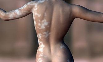 мне напоминает ВИТИЛИГО -болезнь кожи